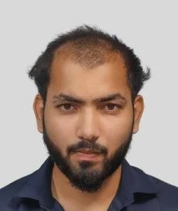 Hair Transplant Before Results - Best Hair Transplant in Delhi