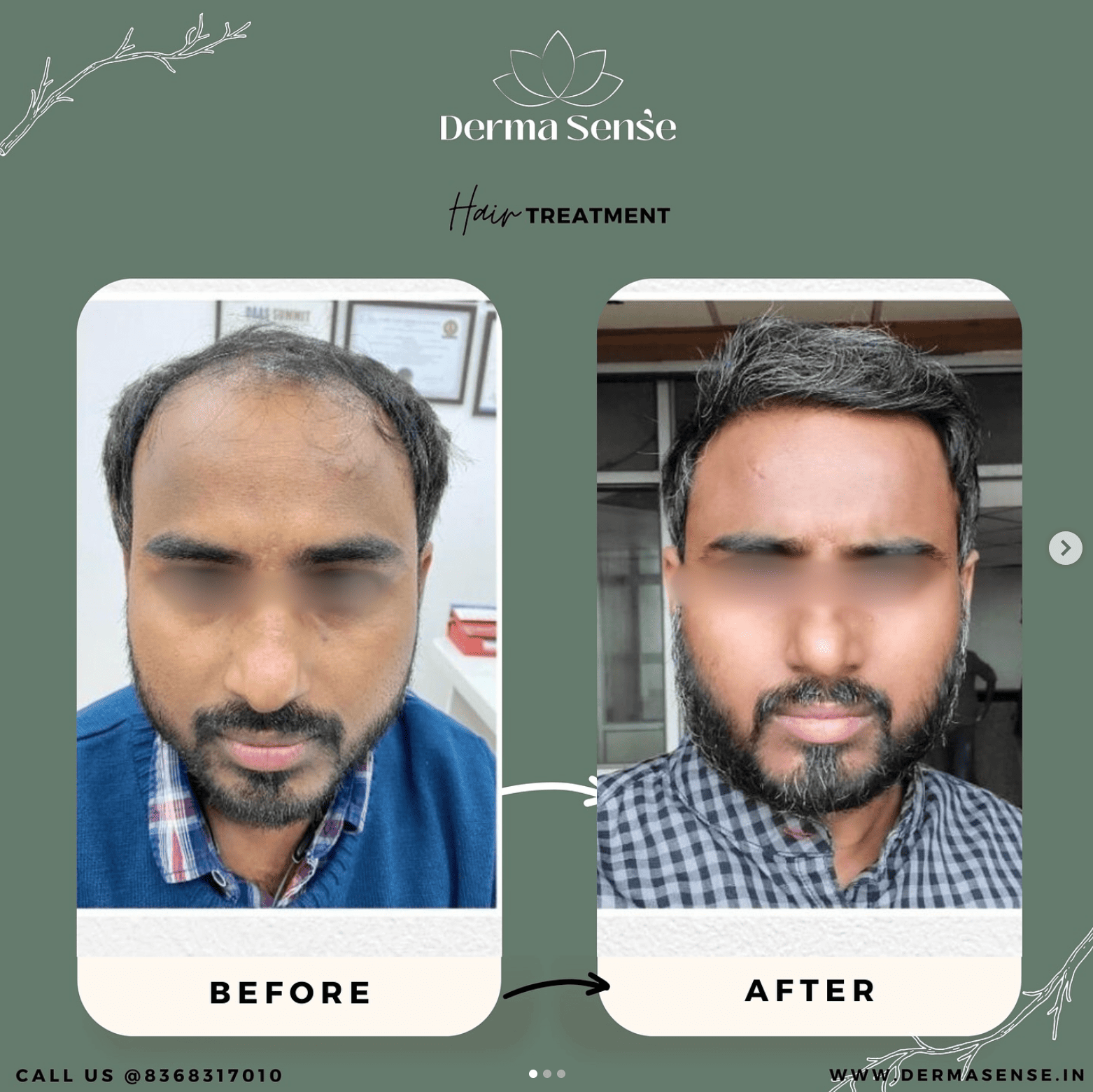 Hair Transplant Before and After Client 3